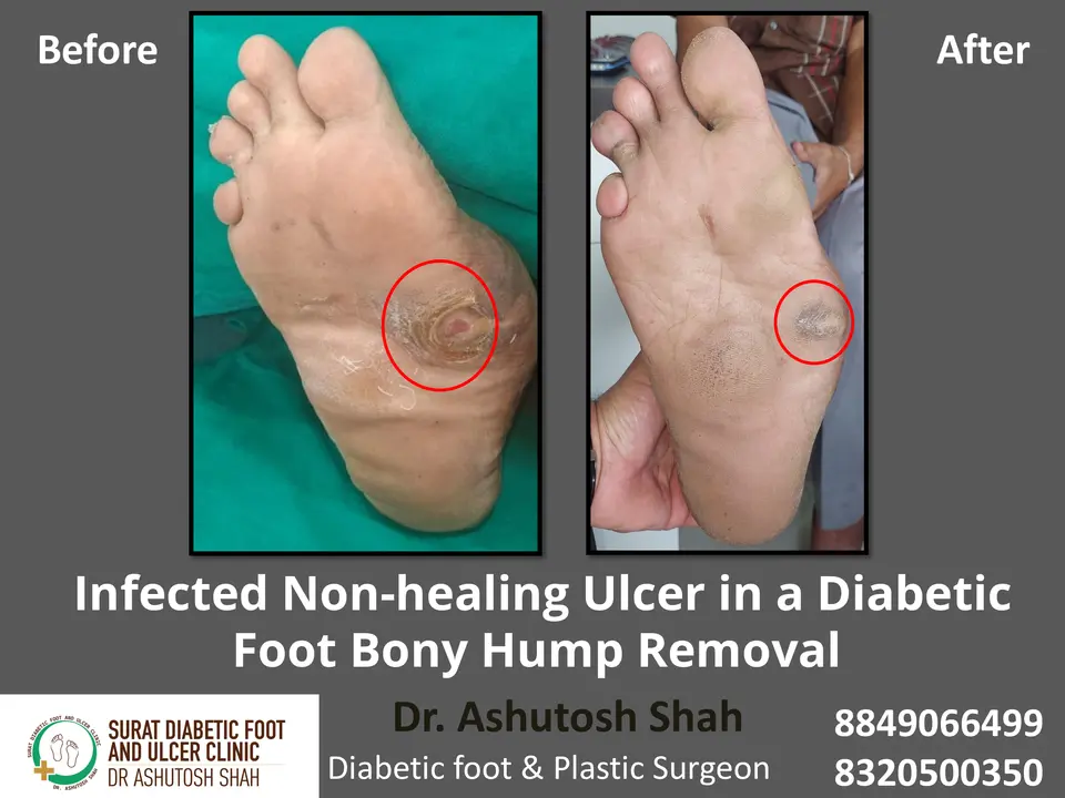 Diabetic Foot  PPT 3 checked by sir.pptx-2.webp